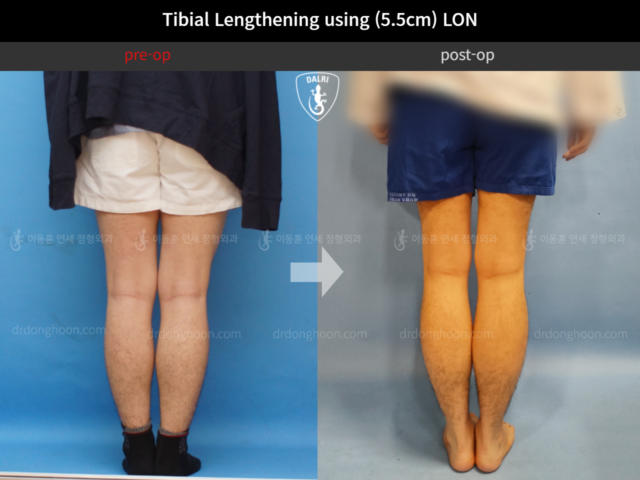 Before and after cll lon, case 4578059, image 4, Dr. Donghoon institute (DALRI)