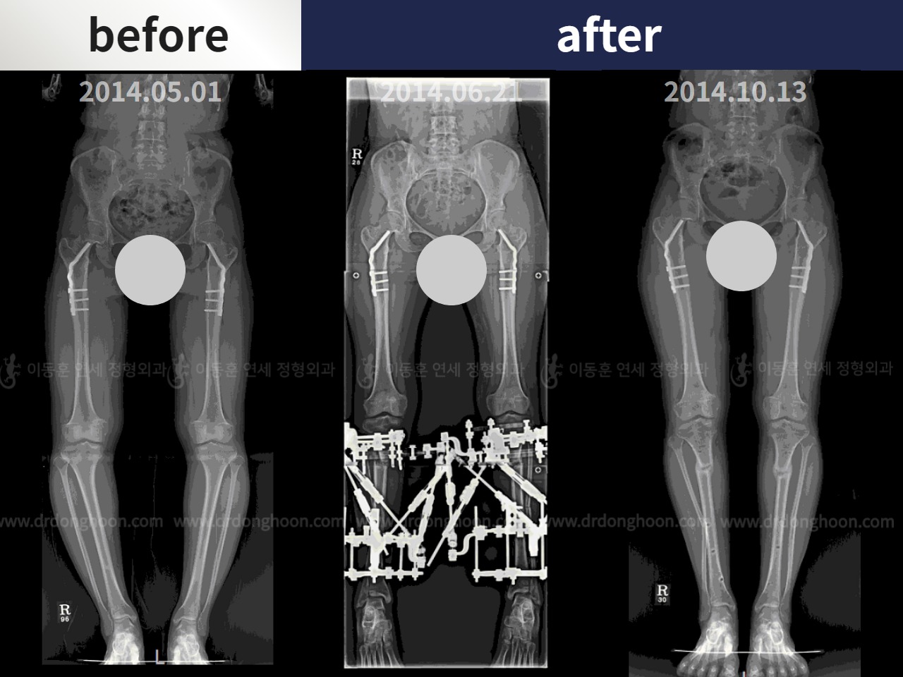 Before and after adult bowlegs, case 4310987, image 3, Dr. Donghoon institute (DALRI)