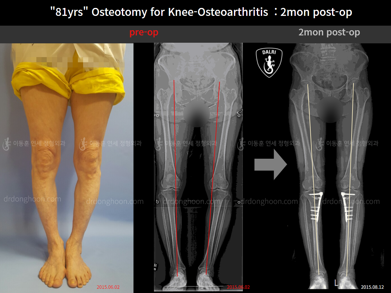 Before and after osteotomy for knee osteoarthritis, case 9864960, image 2, Dr. Donghoon institute (DALRI)