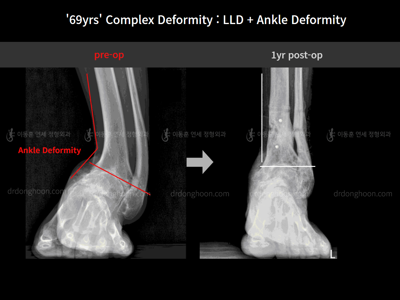 Before and after adult lld, case 8981713, image 7, Dr. Donghoon institute (DALRI)