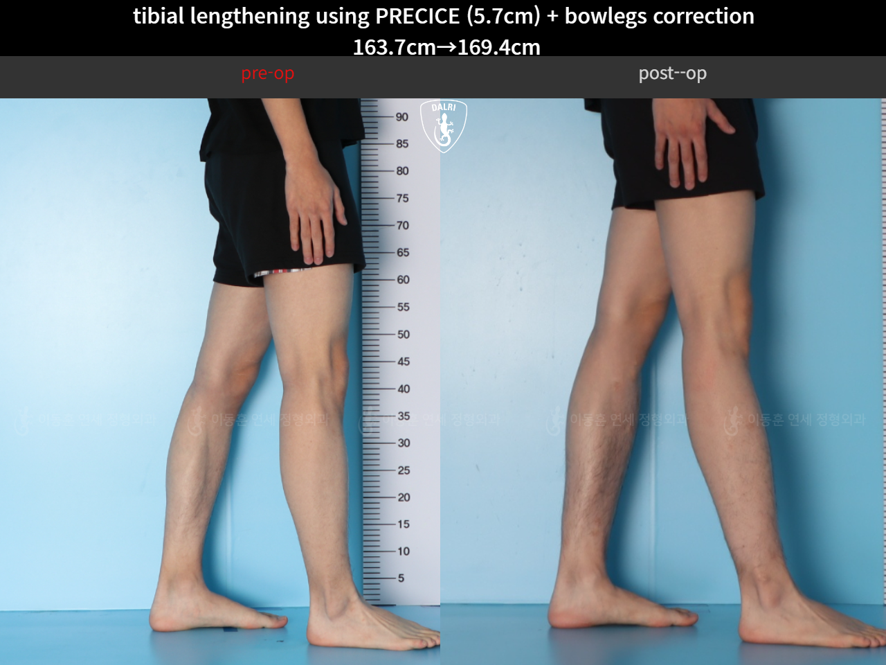 Before and after cll + deformity correction, case 38471595, image 8, Dr. Donghoon institute (DALRI)