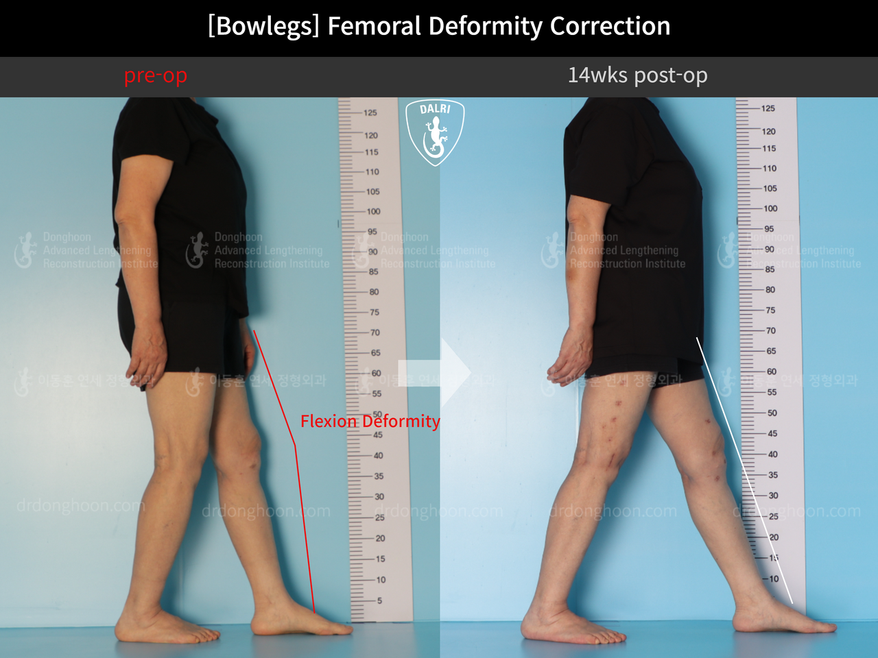 Before and after adult bowlegs, case 12791222, image 4, Dr. Donghoon institute (DALRI)