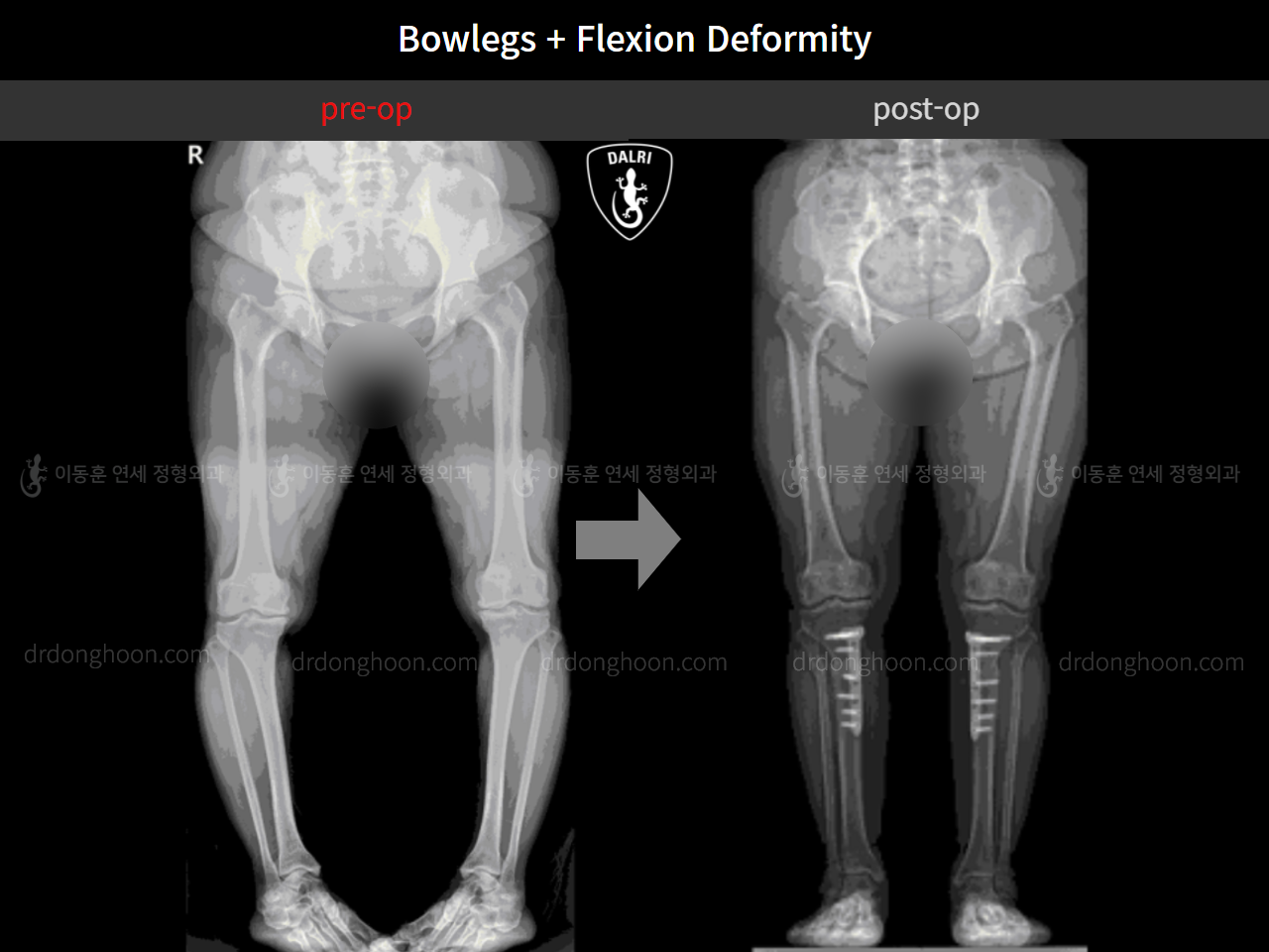 Before and after osteotomy for knee osteoarthritis, case 4586352, image 8, Dr. Donghoon institute (DALRI)