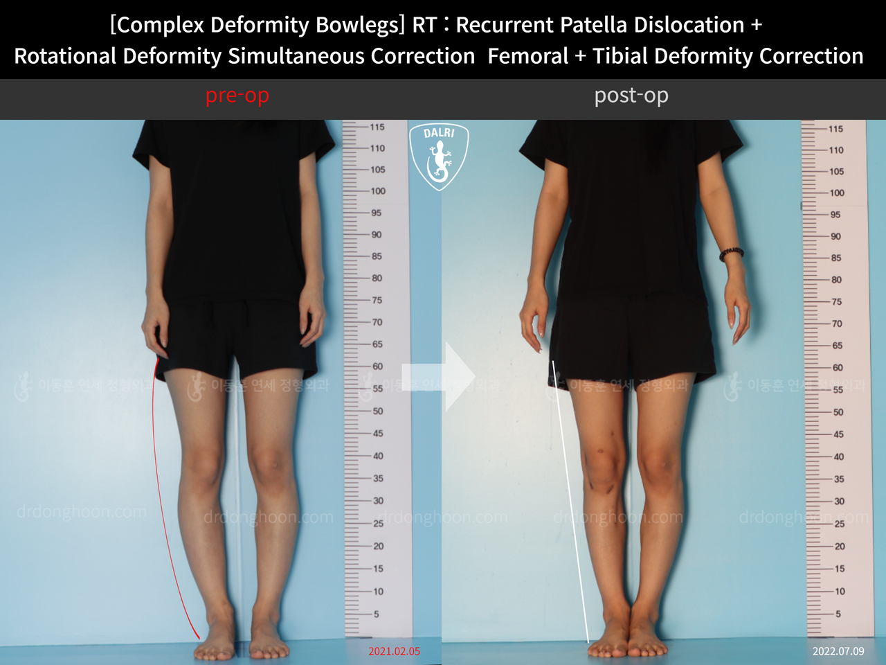 Before and after recurrent patella dislocation, case 12255234, image 1, Dr. Donghoon institute (DALRI)