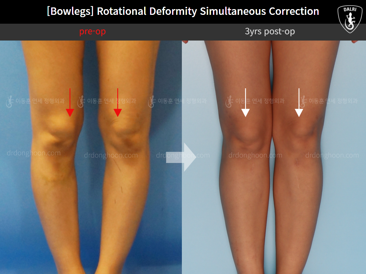 Before and after adult bowlegs, case 11789553, image 8, Dr. Donghoon institute (DALRI)