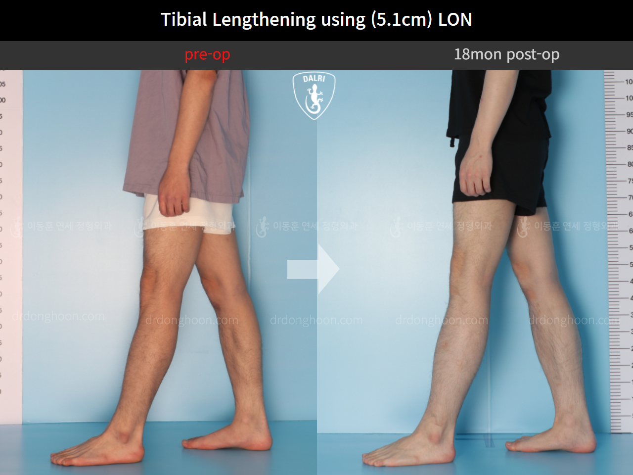 Before and after cll lon, case 9657314, image 7, Dr. Donghoon institute (DALRI)