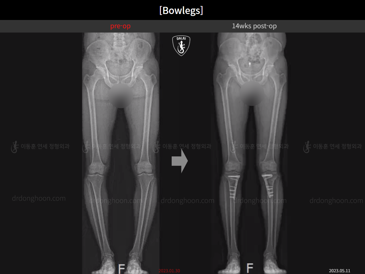 Before and after adult bowlegs, case 15512423, image 13, Dr. Donghoon institute (DALRI)