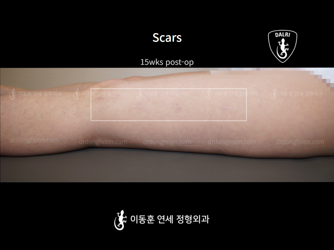 Before and after adult knock knees, case 8259194, image 3, Dr. Donghoon institute (DALRI)