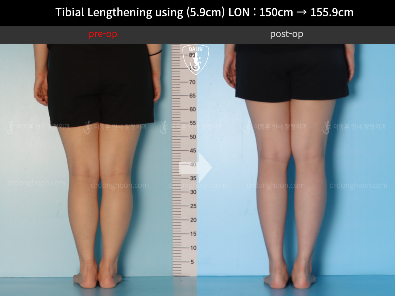 Before and after cll lon, case 12207071, image 6, Dr. Donghoon institute (DALRI)