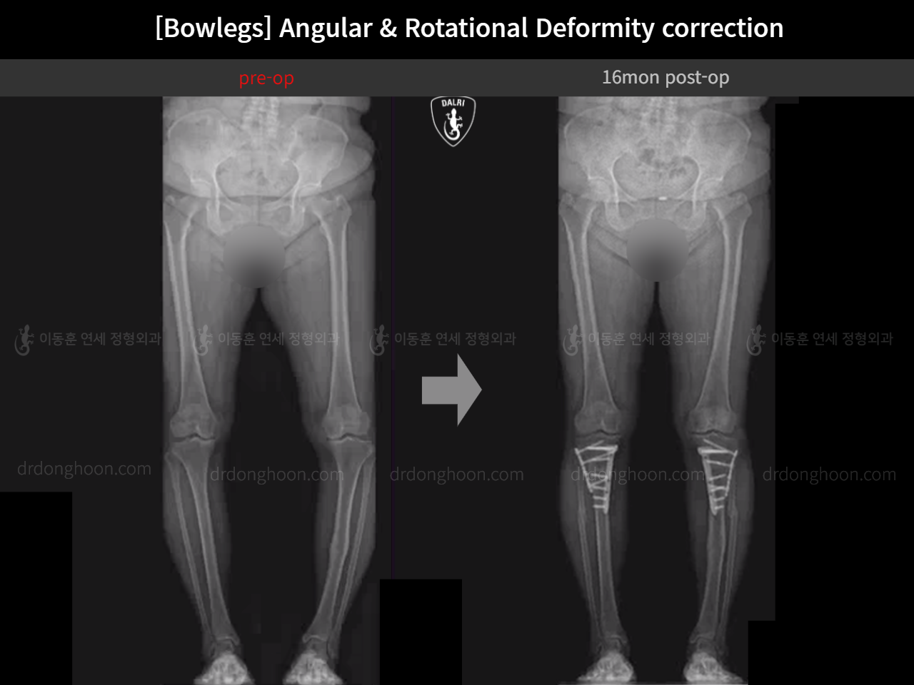 Before and after adult bowlegs, case 14637299, image 6, Dr. Donghoon institute (DALRI)