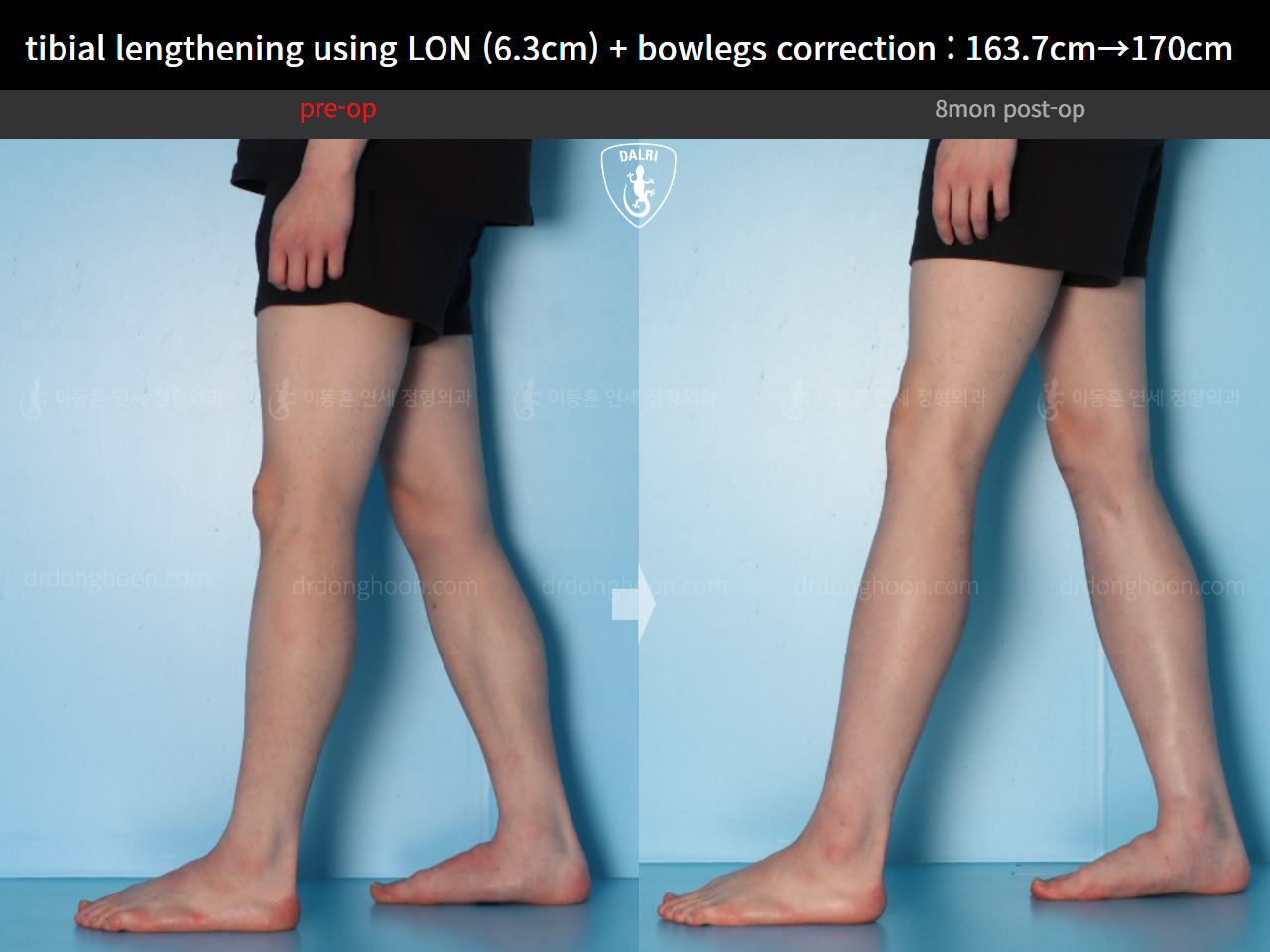 Before and after cll + deformity correction, case 16853829, image 11, Dr. Donghoon institute (DALRI)