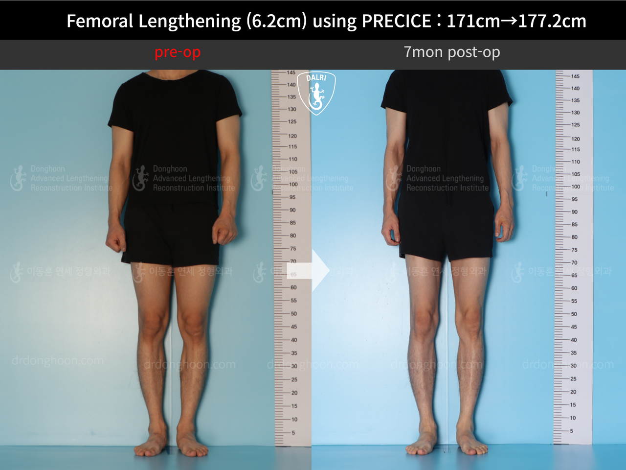 Before and after cll precice, case 13325833, image 2, Dr. Donghoon institute (DALRI)