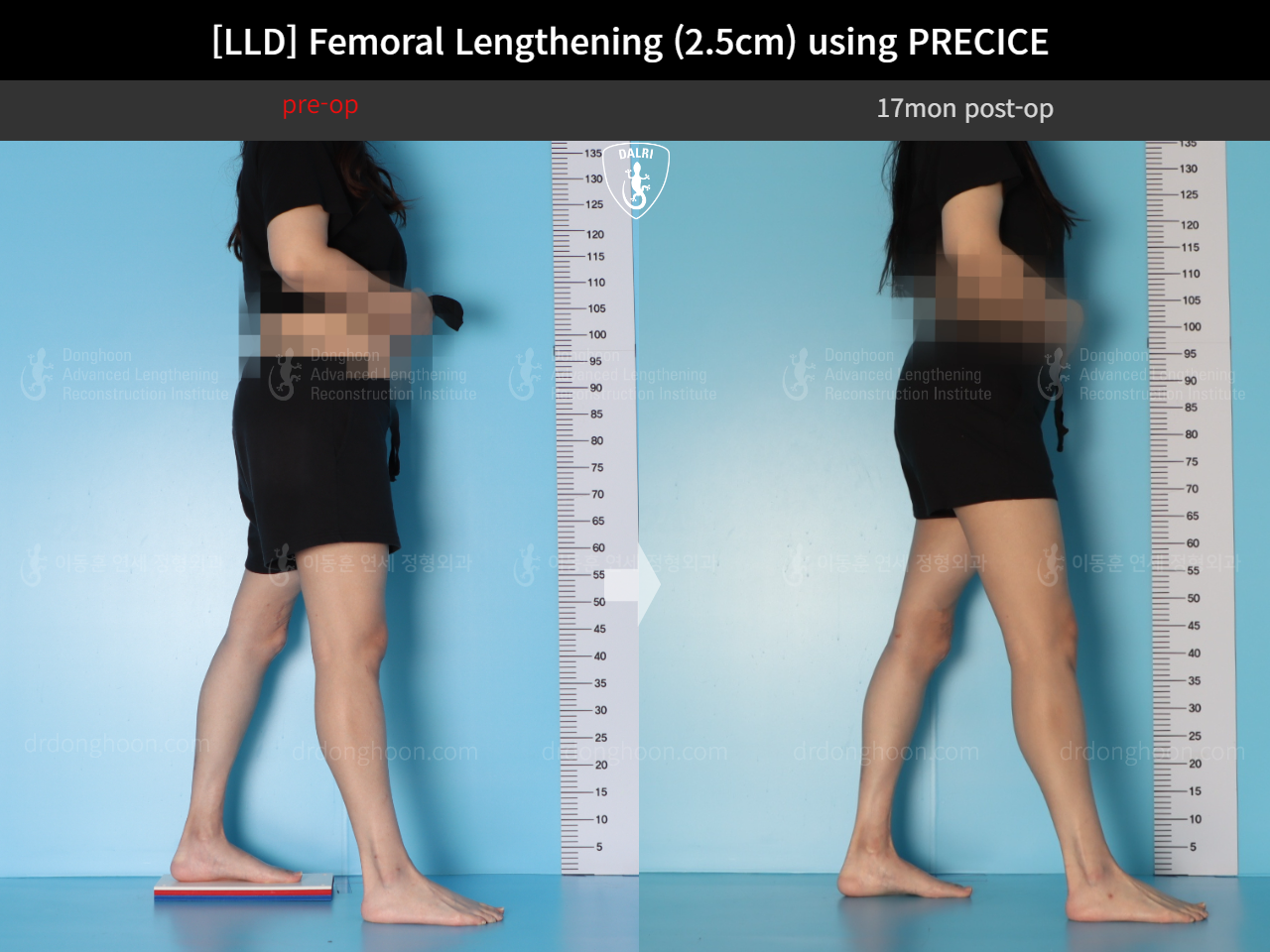 Before and after adult lld, case 18263358, image 4, Dr. Donghoon institute (DALRI)