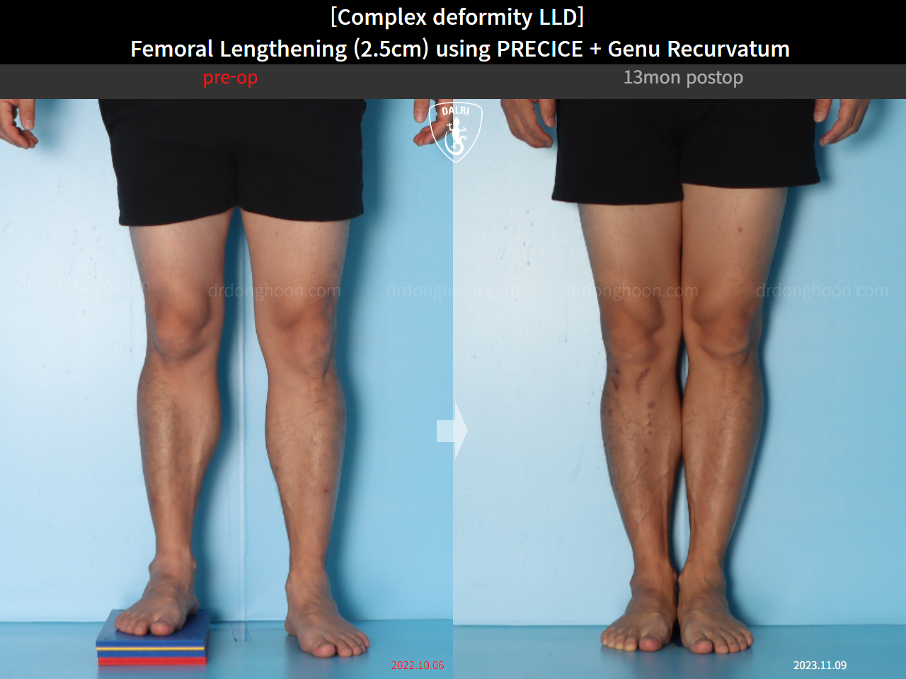 Before and after genu recurvatum, case 16854701, image 7, Dr. Donghoon institute (DALRI)