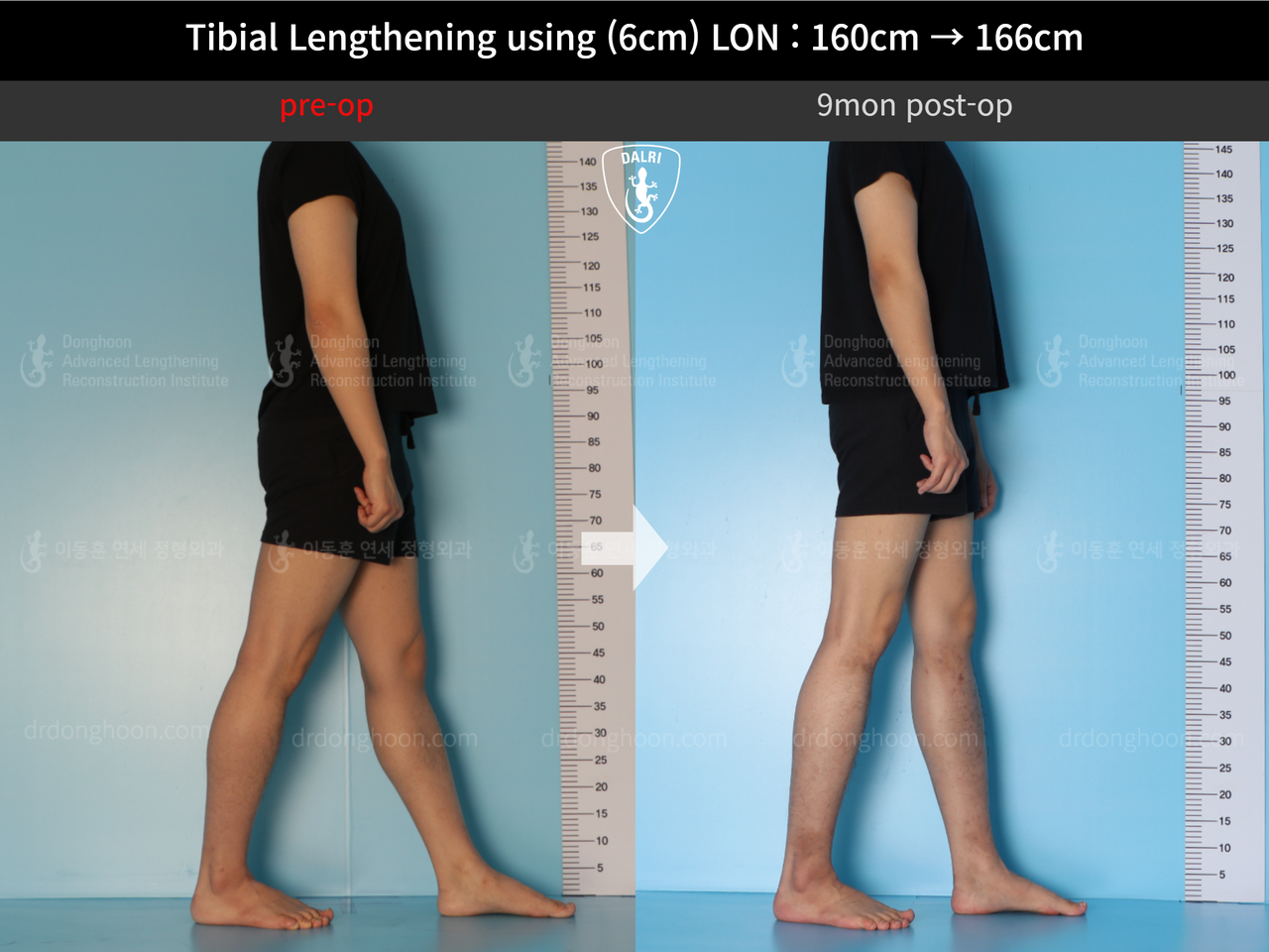 Before and after cll lon, case 13326359, image 4, Dr. Donghoon institute (DALRI)