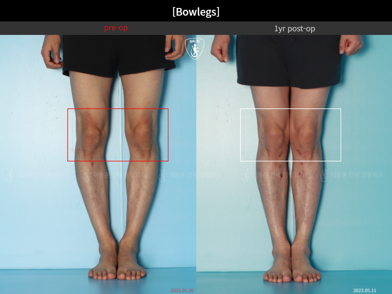 Before and after adult bowlegs, case 32564251, image 10, Dr. Donghoon institute (DALRI)