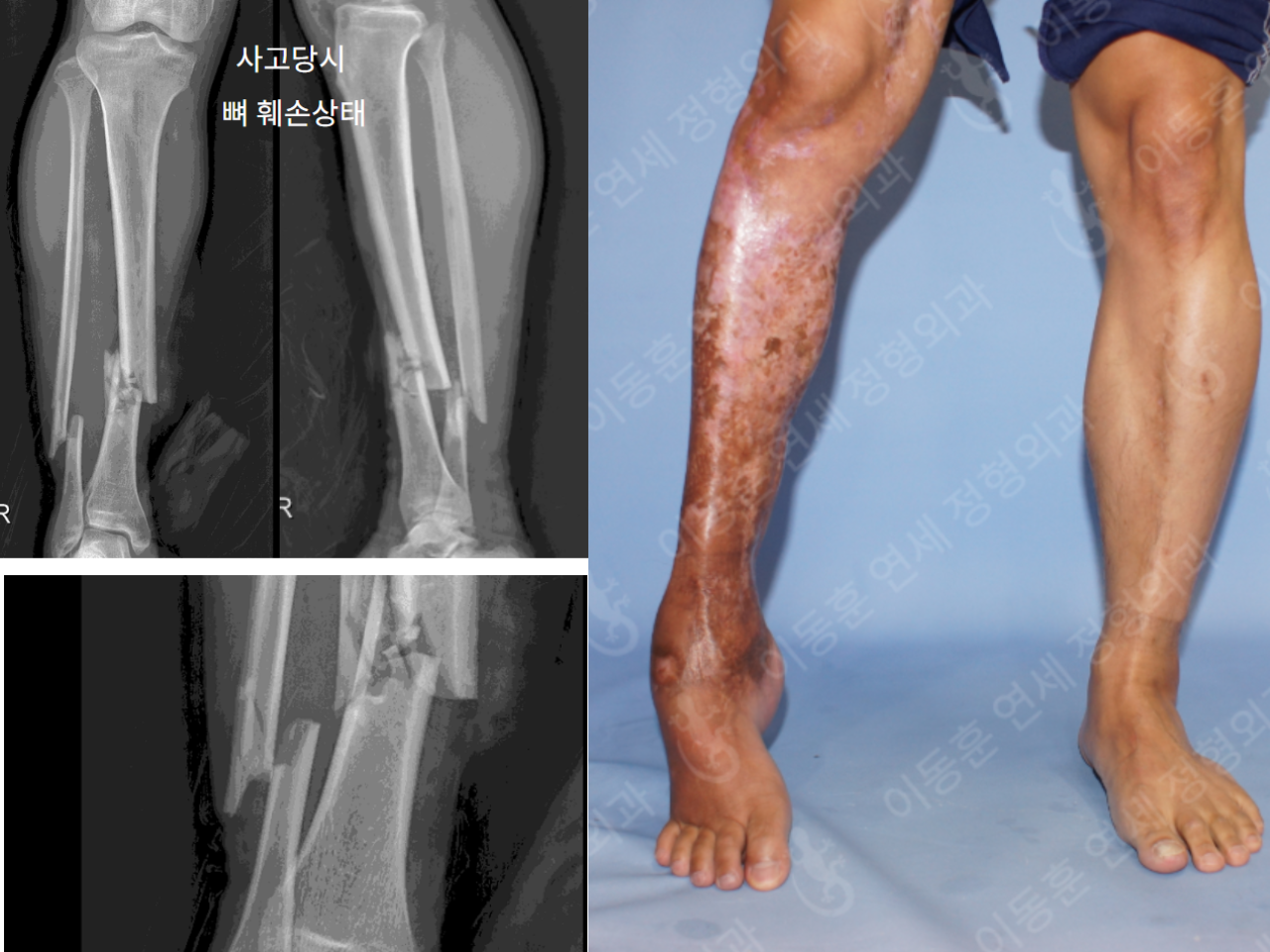 Before and after post-trauma deformity, case 4251815, image 3, Dr. Donghoon institute (DALRI)