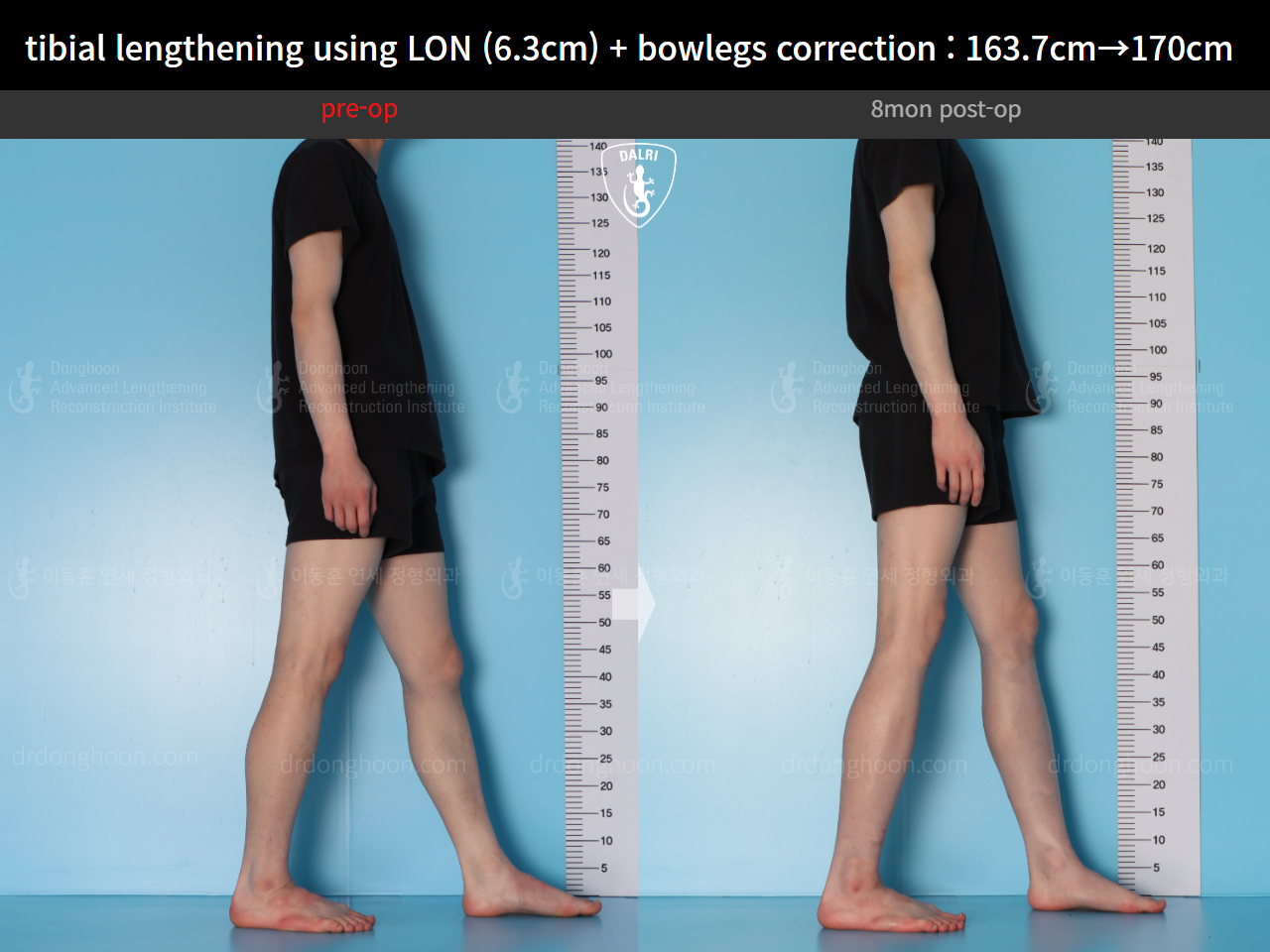 Before and after cll + deformity correction, case 16853829, image 6, Dr. Donghoon institute (DALRI)