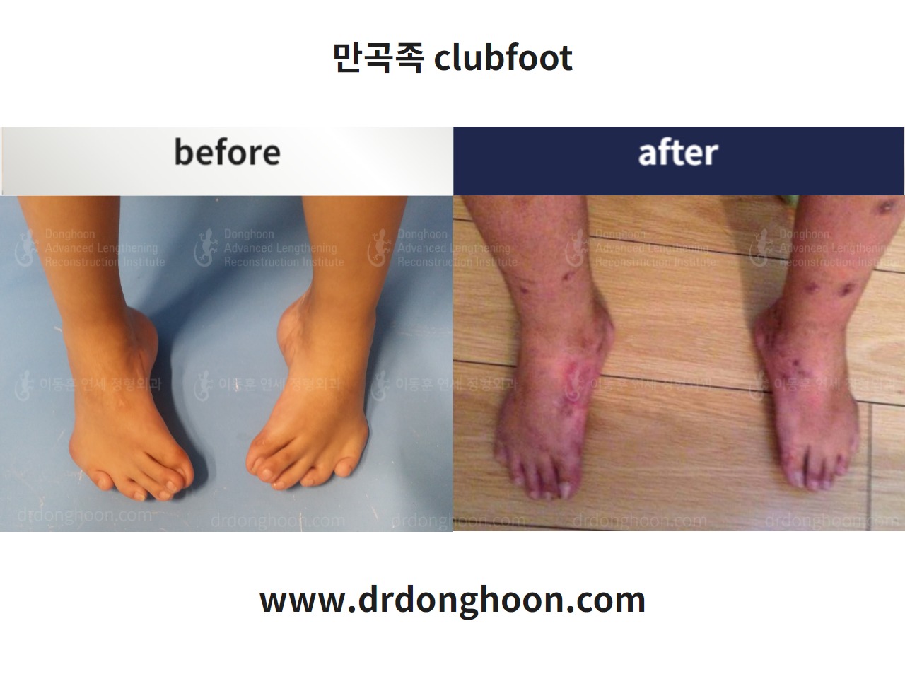 Before and after paediatric congenital condition, case 4304733, image 3, Dr. Donghoon institute (DALRI)