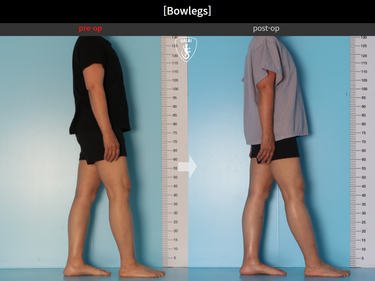 Before and after adult bowlegs, case 30770070, image 6, Dr. Donghoon institute (DALRI)