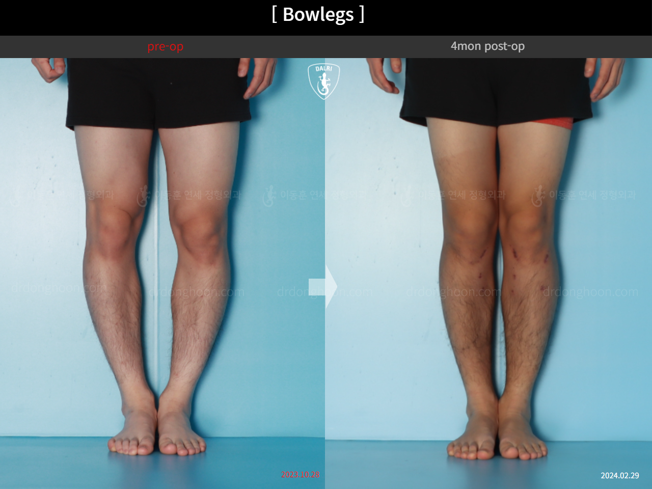 Before and after adult bowlegs, case 18479637, image 6, Dr. Donghoon institute (DALRI)