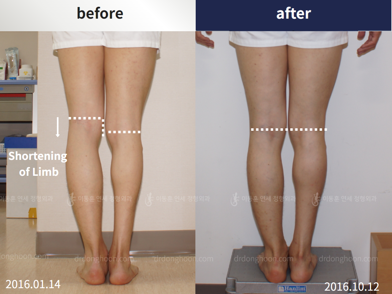 Before and after shortening of limb, case 4232448, image 2, Dr. Donghoon institute (DALRI)