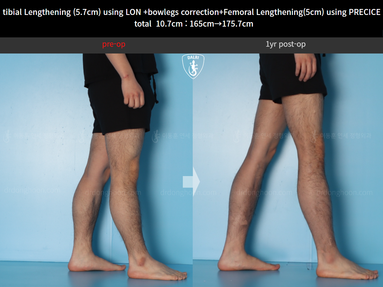 Before and after cll + deformity correction, case 20363398, image 10, Dr. Donghoon institute (DALRI)