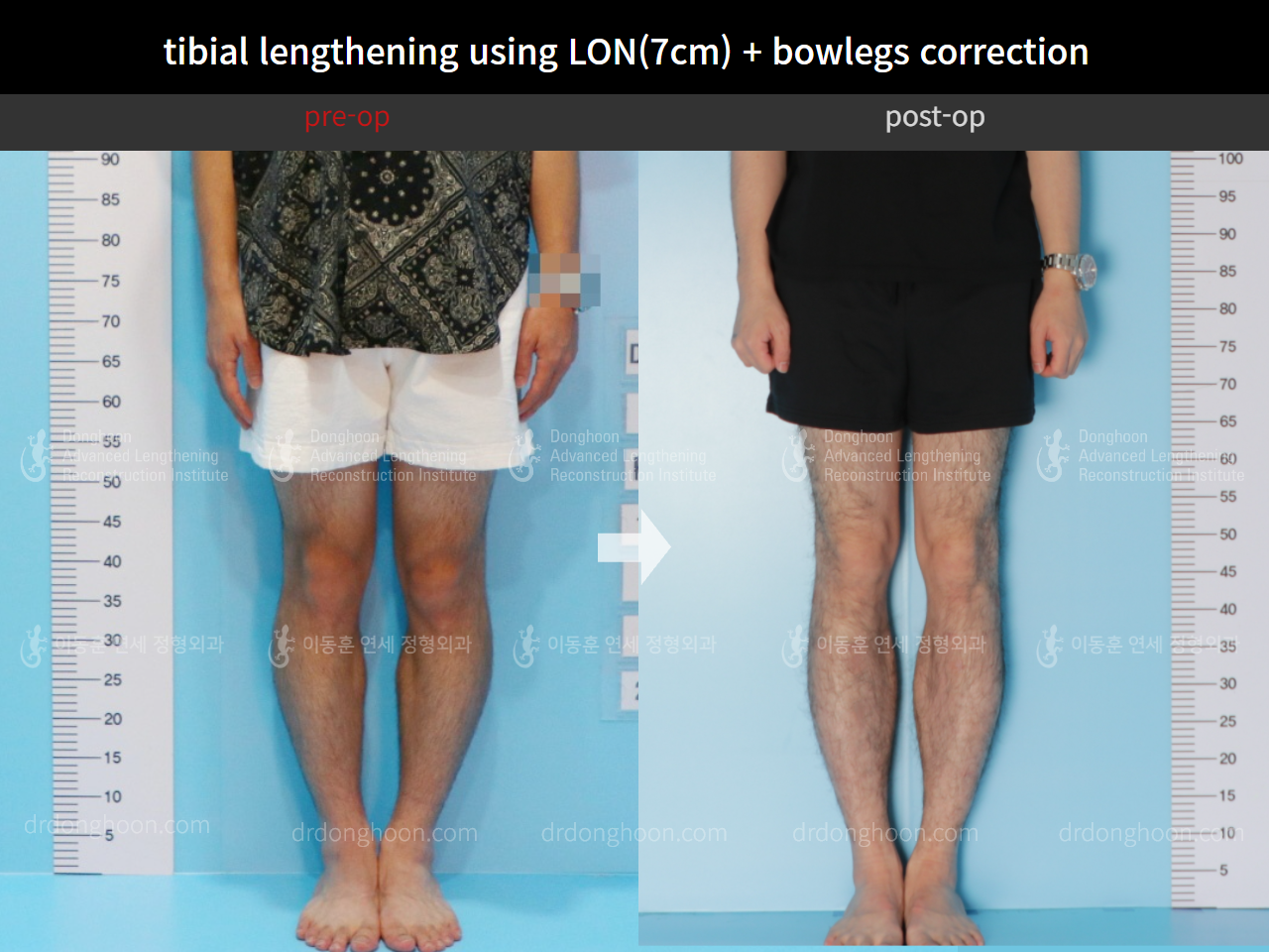 Before and after cll + deformity correction, case 4585644, image 5, Dr. Donghoon institute (DALRI)