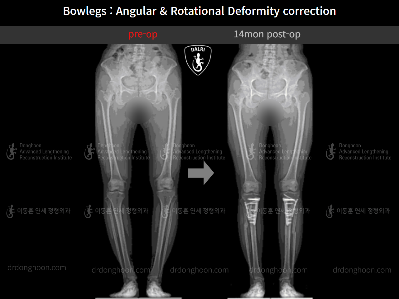 Before and after adult bowlegs, case 9557826, image 7, Dr. Donghoon institute (DALRI)