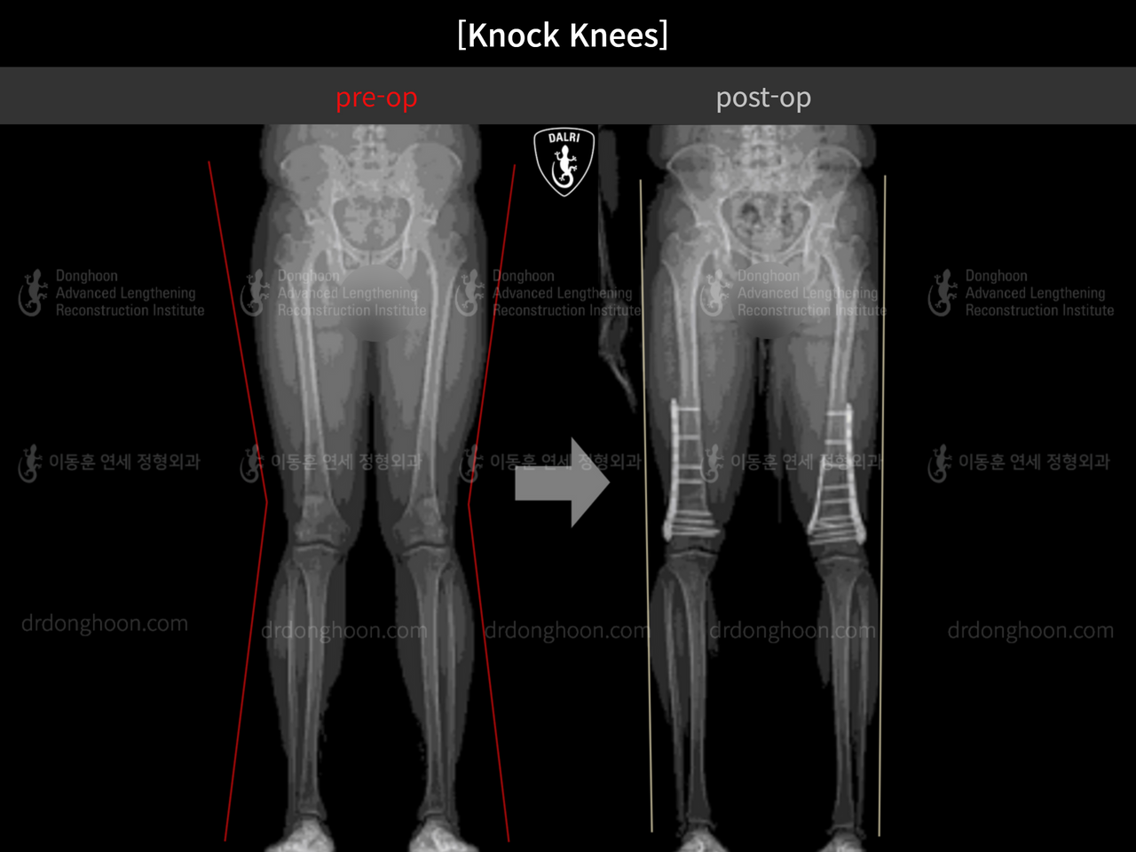 Before and after adult knock knees, case 13002083, image 3, Dr. Donghoon institute (DALRI)
