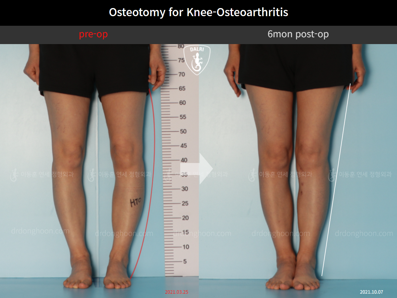 Before and after osteotomy for knee osteoarthritis, case 10451826, image 3, Dr. Donghoon institute (DALRI)
