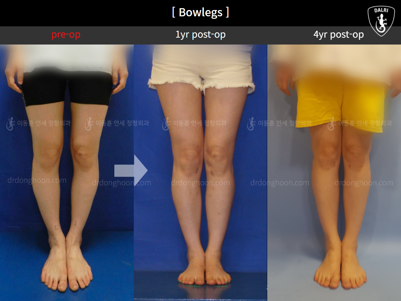 Before and after adult bowlegs, case 4310976, image 2, Dr. Donghoon institute (DALRI)