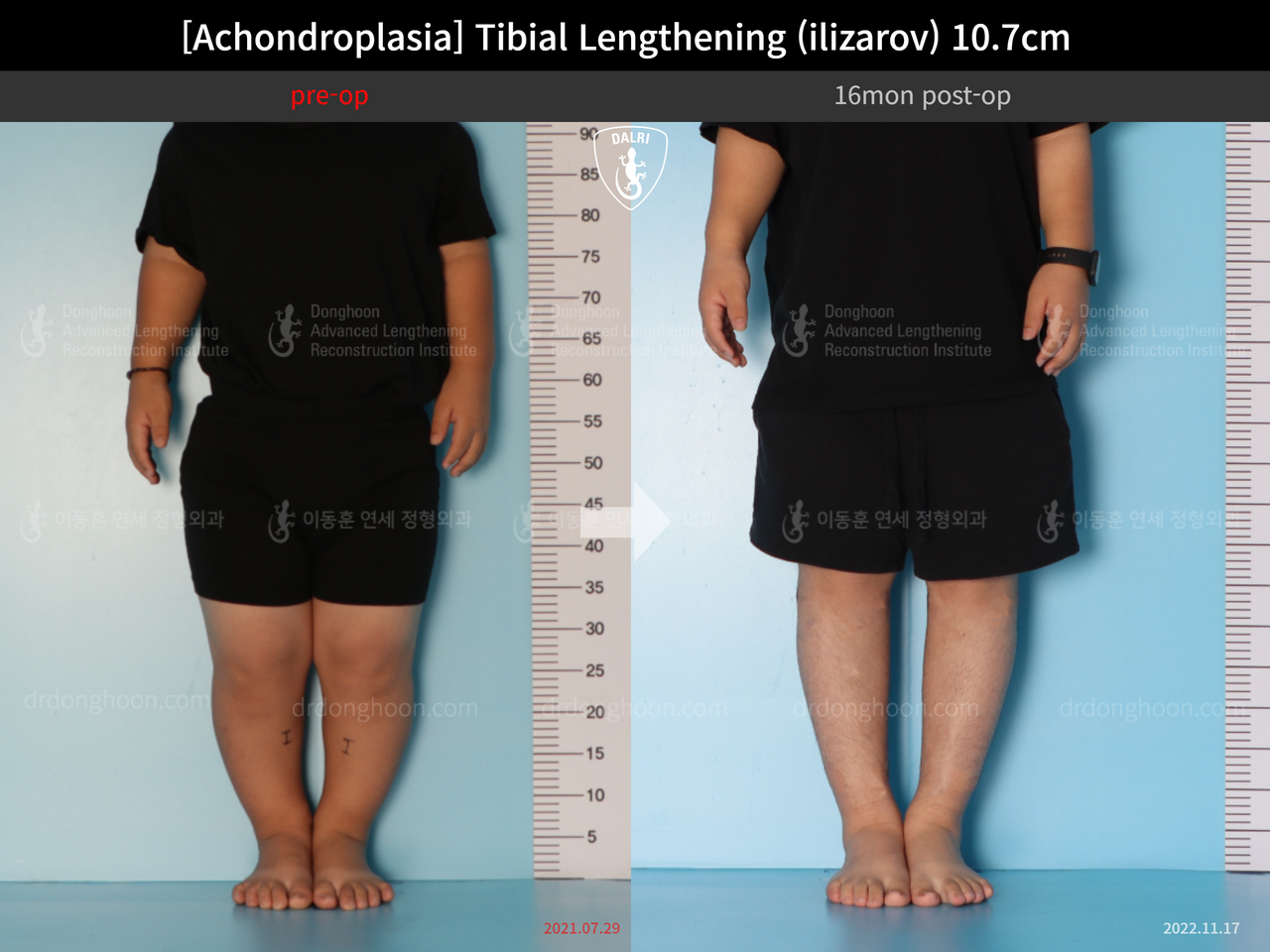 Before and after paediatric congenital condition, case 13489647, image 3, Dr. Donghoon institute (DALRI)