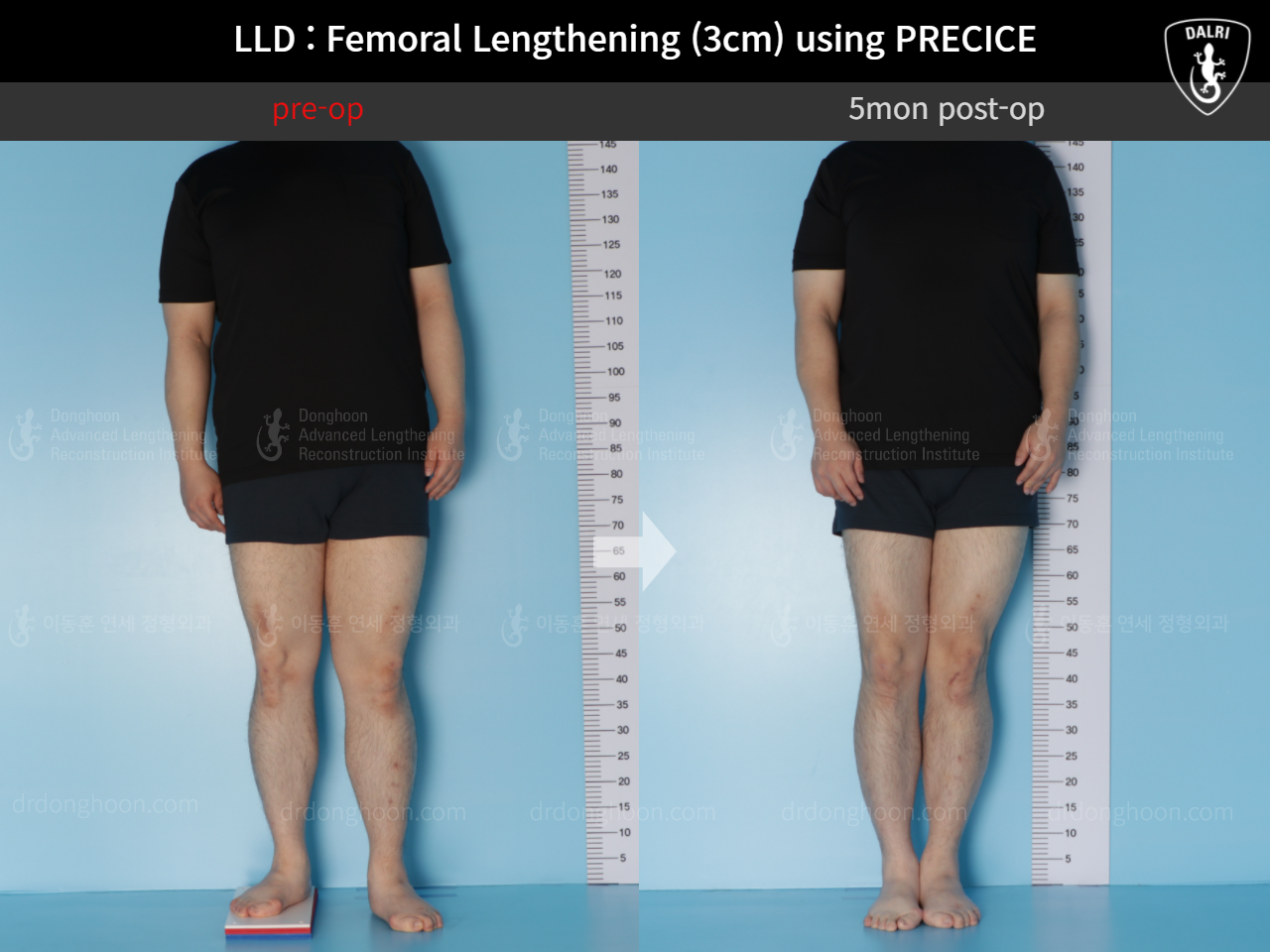 Before and after adult lld, case 5346187, image 3, Dr. Donghoon institute (DALRI)