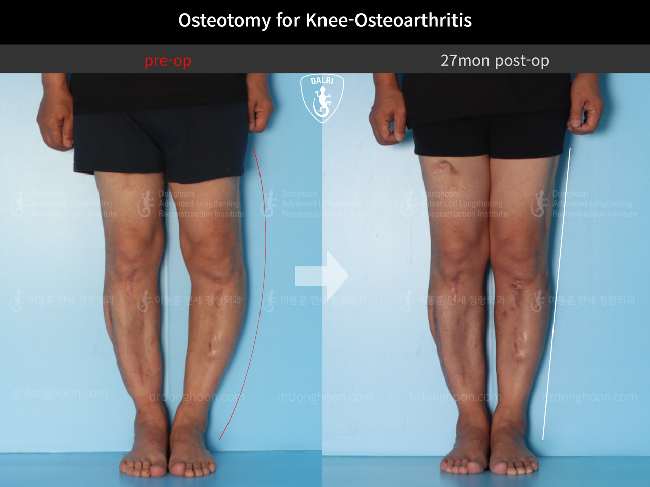 Before and after osteotomy for knee osteoarthritis, case 12535590, image 5, Dr. Donghoon institute (DALRI)