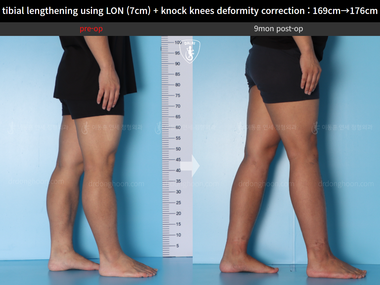 Before and after cll + deformity correction, case 15748291, image 6, Dr. Donghoon institute (DALRI)