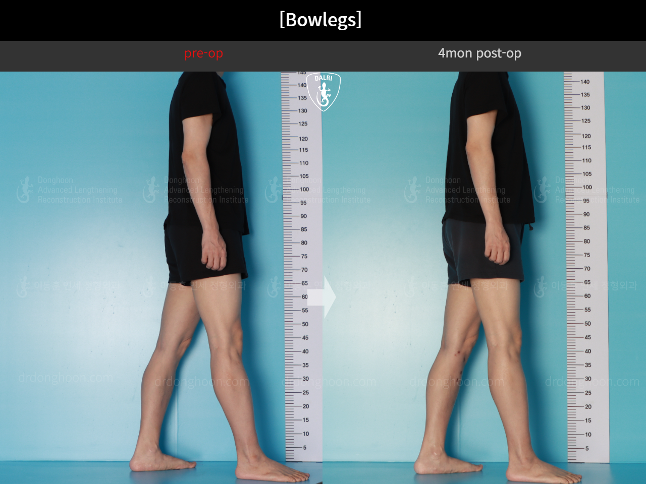 Before and after adult bowlegs, case 17962599, image 6, Dr. Donghoon institute (DALRI)