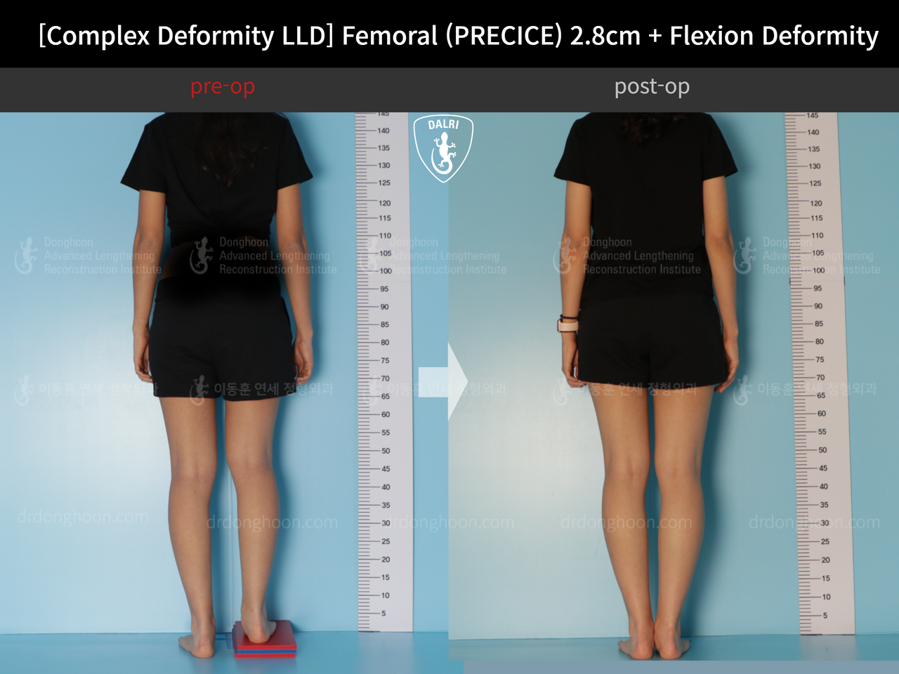 Before and after adult lld, case 13168213, image 2, Dr. Donghoon institute (DALRI)