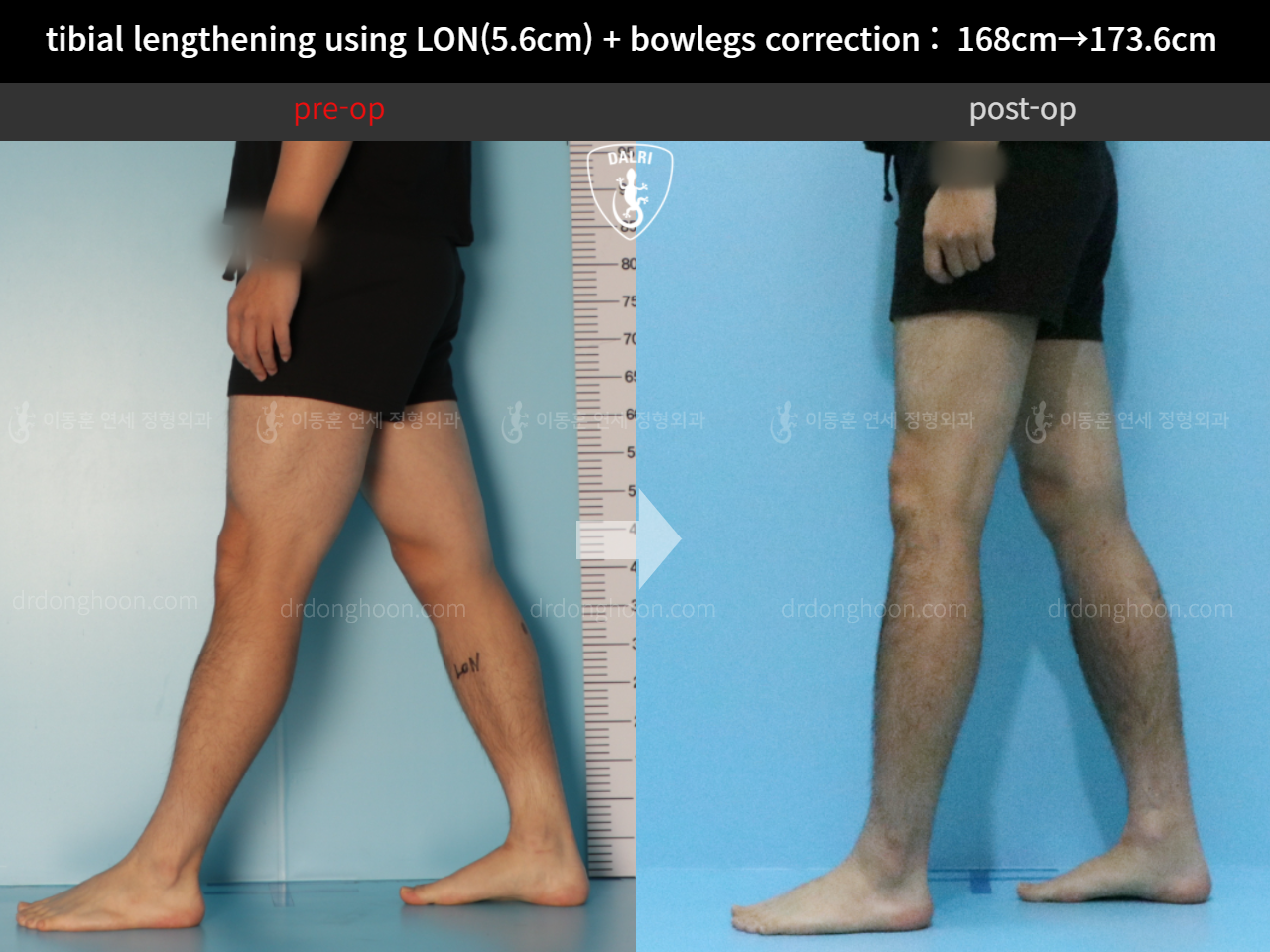 Before and after cll + deformity correction, case 11802994, image 8, Dr. Donghoon institute (DALRI)