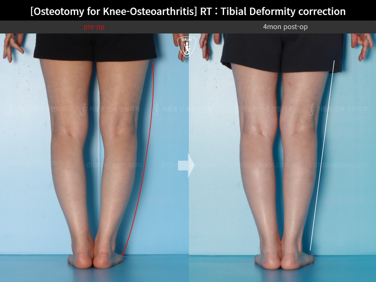 Before and after osteotomy for knee osteoarthritis, case 17890677, image 8, Dr. Donghoon institute (DALRI)