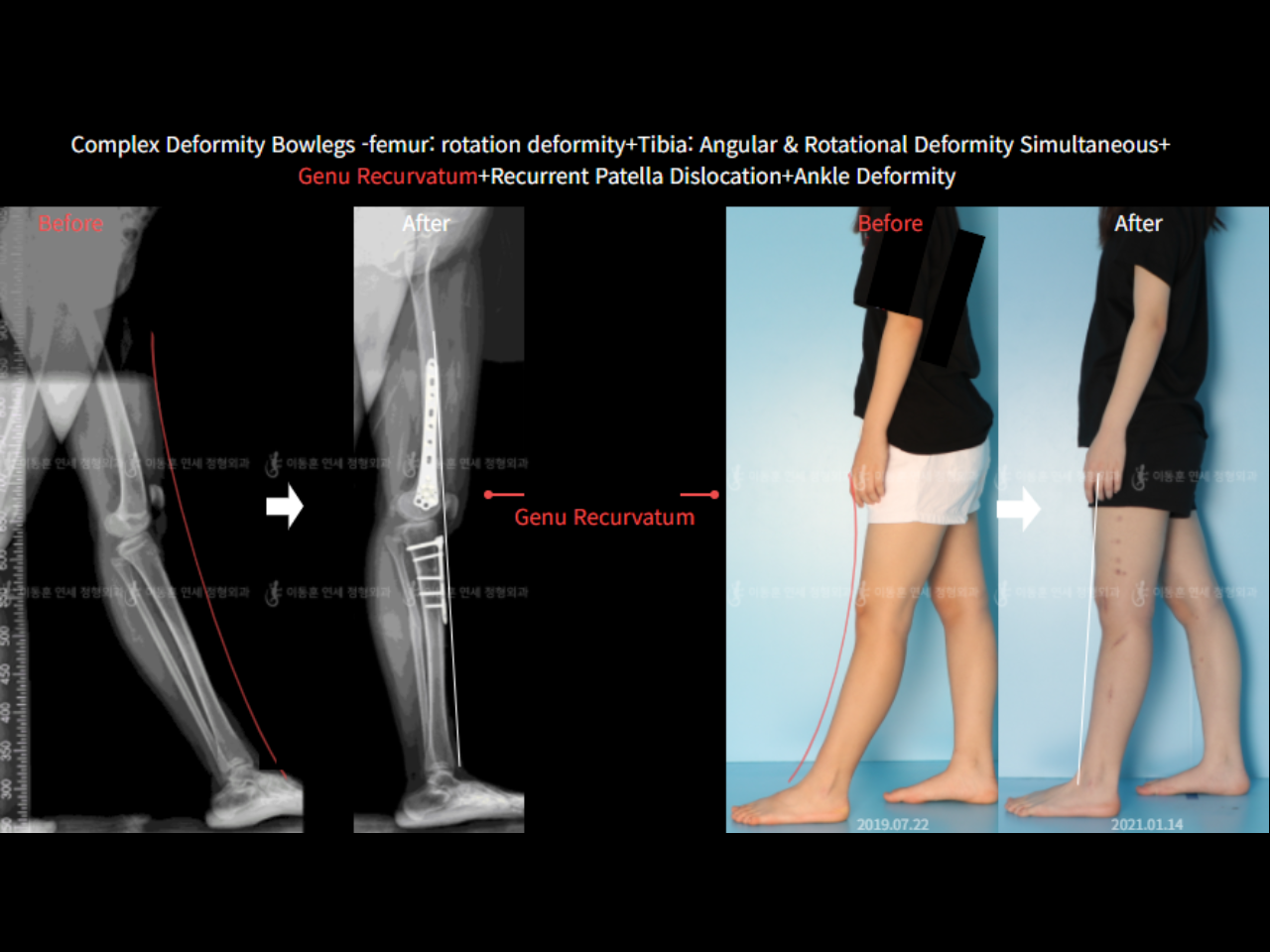 Before and after adult bowlegs, case 6883070, image 4, Dr. Donghoon institute (DALRI)