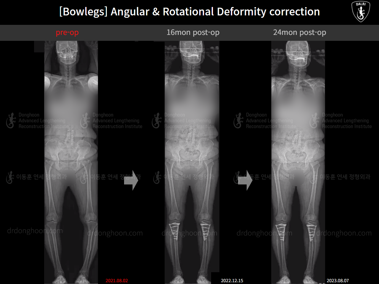 Before and after adult bowlegs, case 16074478, image 8, Dr. Donghoon institute (DALRI)