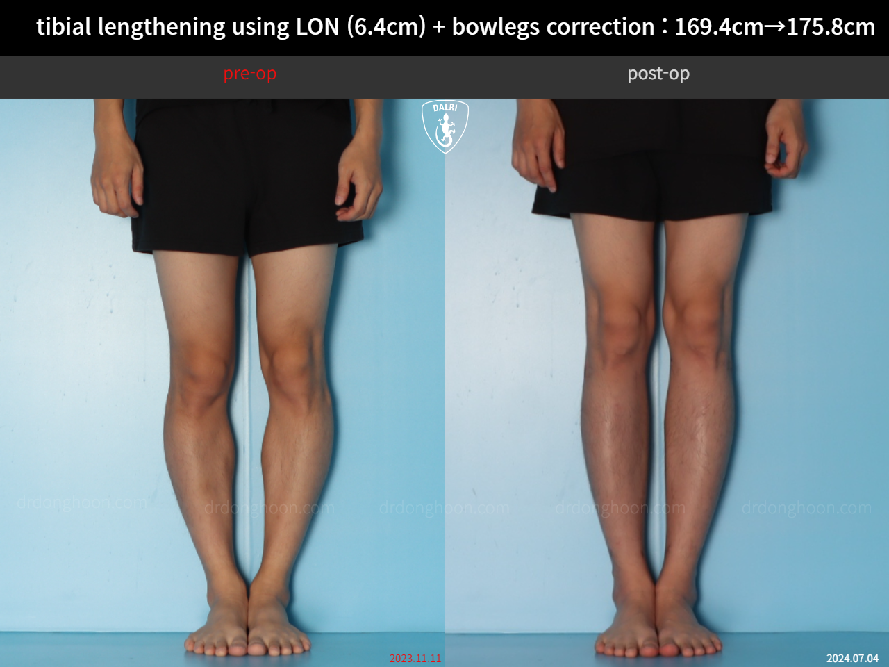 Before and after cll + deformity correction, case 36736776, image 7, Dr. Donghoon institute (DALRI)