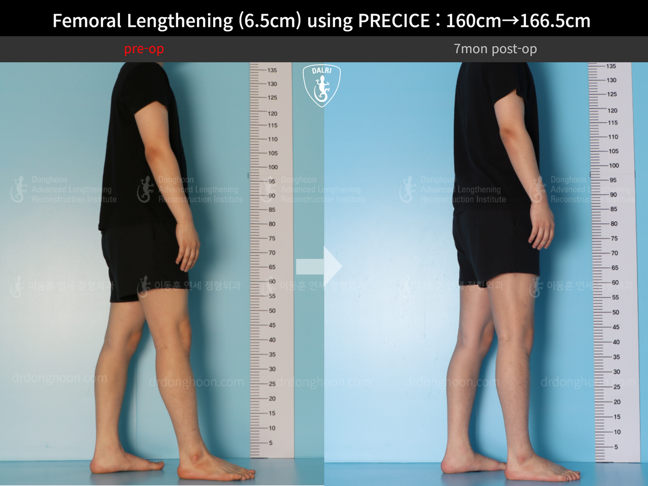 Before and after cll precice, case 13413485, image 5, Dr. Donghoon institute (DALRI)