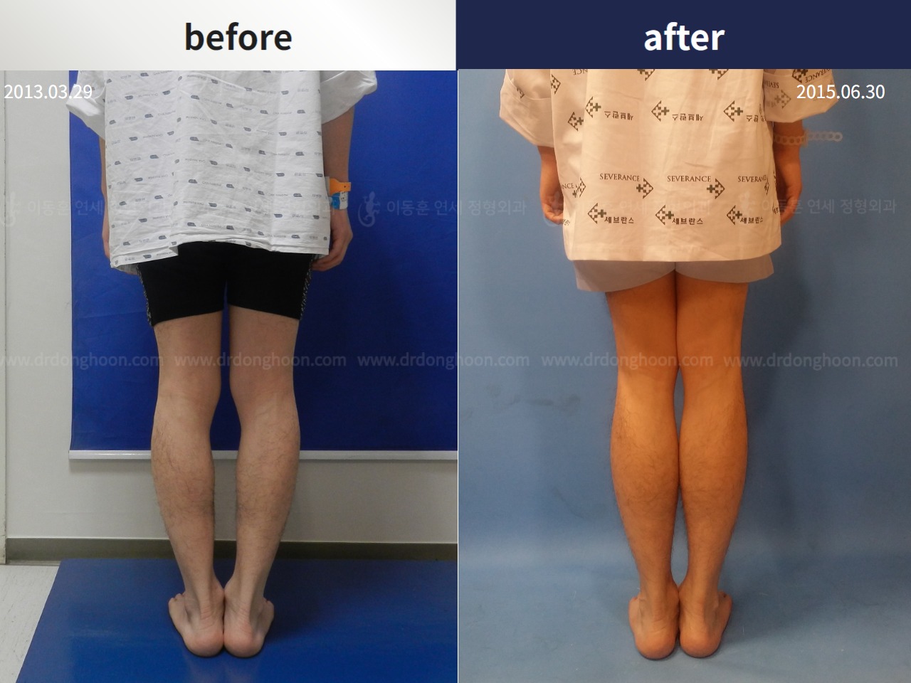 Before and after cll + deformity correction, case 4323089, image 2, Dr. Donghoon institute (DALRI)
