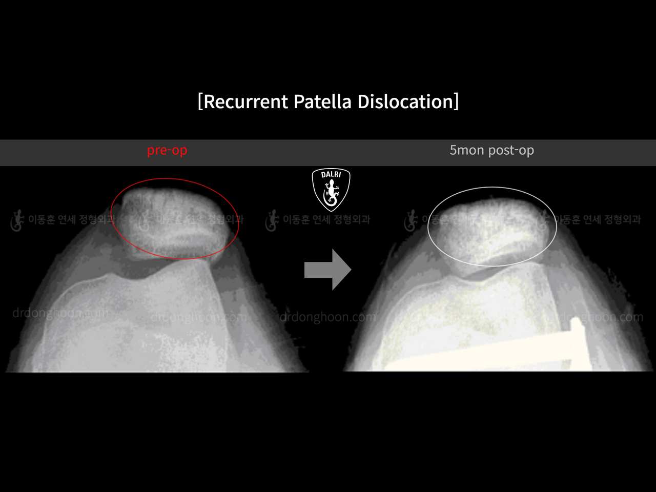 Before and after recurrent patella dislocation, case 13337596, image 7, Dr. Donghoon institute (DALRI)