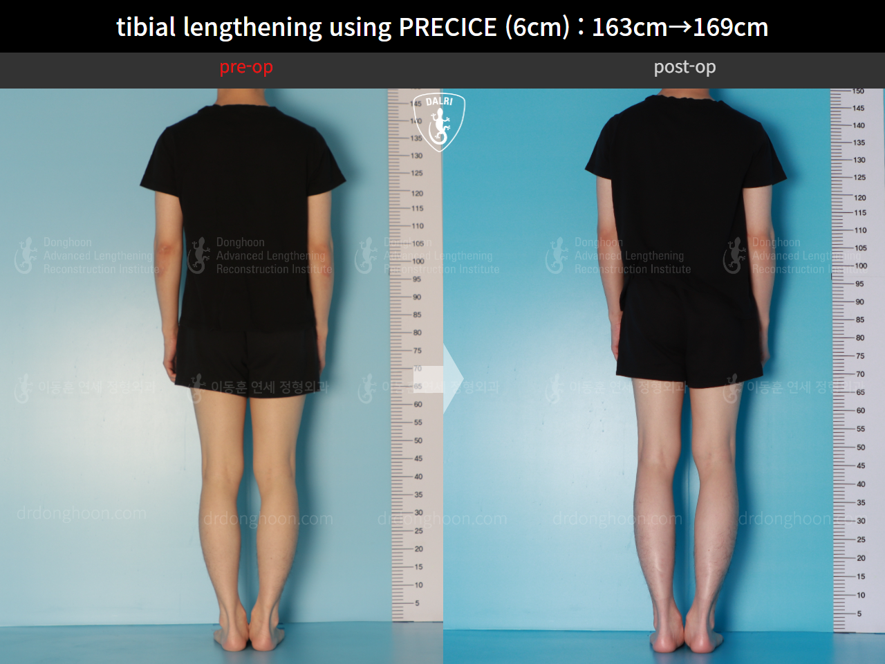 Before and after cll precice, case 16061529, image 3, Dr. Donghoon institute (DALRI)