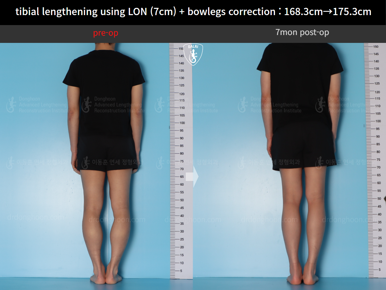 Before and after cll + deformity correction, case 21918246, image 2, Dr. Donghoon institute (DALRI)