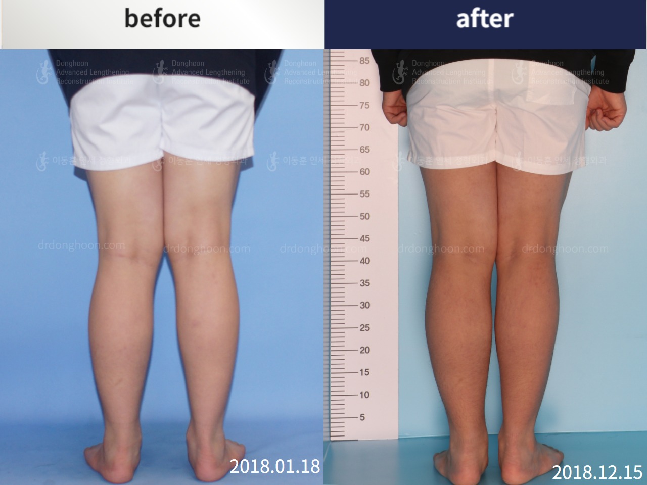 Before and after paediatric & adolescent knock knees, case 4310902, image 2, Dr. Donghoon institute (DALRI)