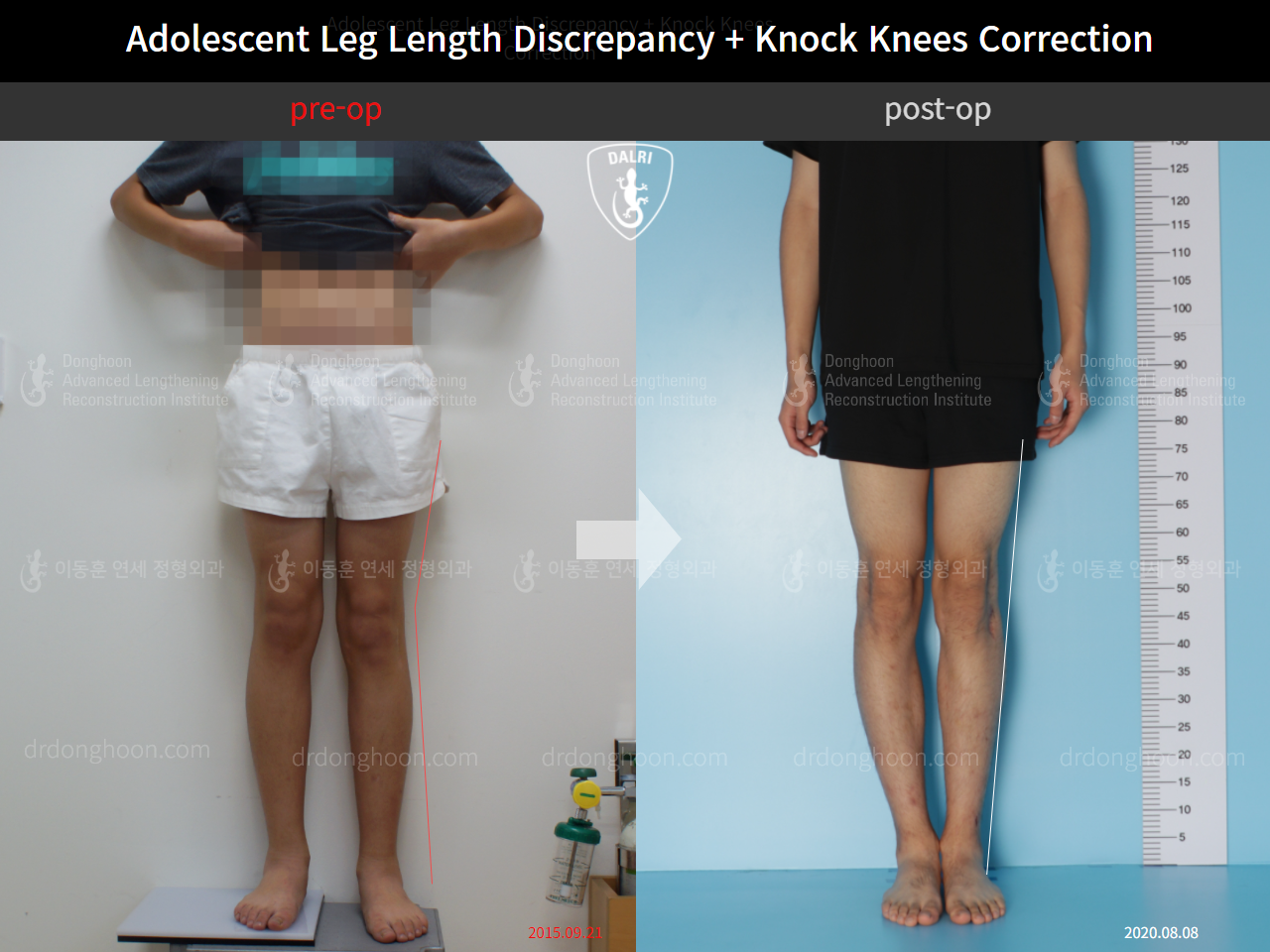 Before and after paediatric & adolescent lld, case 4585692, image 1, Dr. Donghoon institute (DALRI)